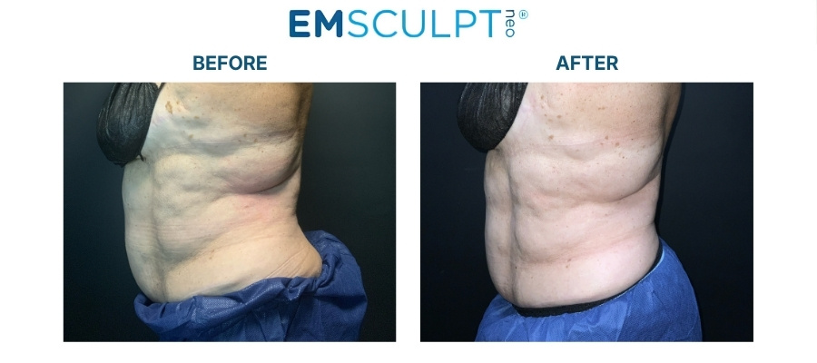 emsculpt-neo-dr.-julia-edelman-middleboro-before-and-after-image-4